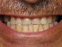 Tooth Wear, Before