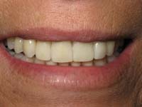 Veneers, After