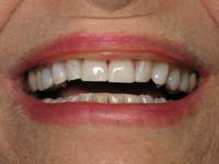 Veneers, After