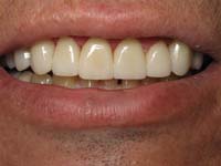 Veneers, After