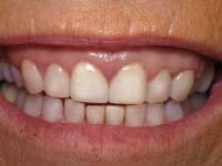 Veneers, After